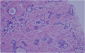 Histopathology showed multiple small tubules, cysts, and nest forming by epithelial proliferation, with some of them morphologically like a comma or a tadpole, in the superficial dermis (Hematoxilin & eosin, X40).