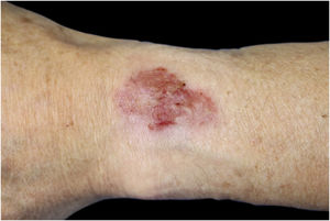 Clinical features showing well-defined erythematous plaque with erosion and crusts in the area covered by the metal wristwatch on the left wrist.