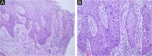 (A) Low power view of a biopsy specimen from the wrist shows irregular acanthosis and full-thickness dysplasia of the epidermis without infiltration of atypical cells into the dermis. (Hematoxylin & eosin, ×100). (B) Higher magnification shows the epidermis with hyperchromatic nuclei, atypia, and numerous mitoses. (Hematoxylin & eosin, ×200).