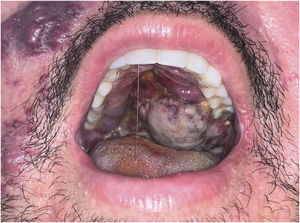 Infiltrated violaceous tumor and areas of leukoplakia on the palate.