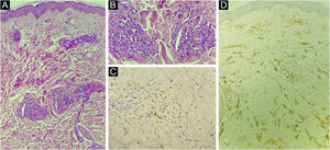 (A) Atypical vascular proliferation, with irregular vessels and endothelial atypia (Hematoxylin & eosin, low power). (B) Detail of the vascular neoplasia (Hematoxylin & eosin, ×100). (C) Immunohistochemistry of the skin fragment showing positivity for human herpes virus 8 (HHV8). (D) Immunohistochemistry of the skin fragment showing positivity for the endothelial cell marker CD31.