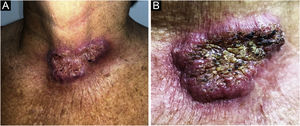 (A) Erythematous-infiltrated plaque with hyperkeratotic surface on the anterior cervical region. (B) Details of the erythematous-infiltrated plaque, showing pustules, meliceric crusts and black dots.