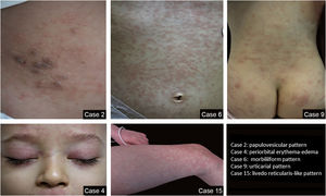 Some of the patterns of rashes in the study group.