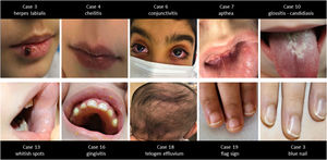 Some of the mucosa, nail and hair findings of the study group.
