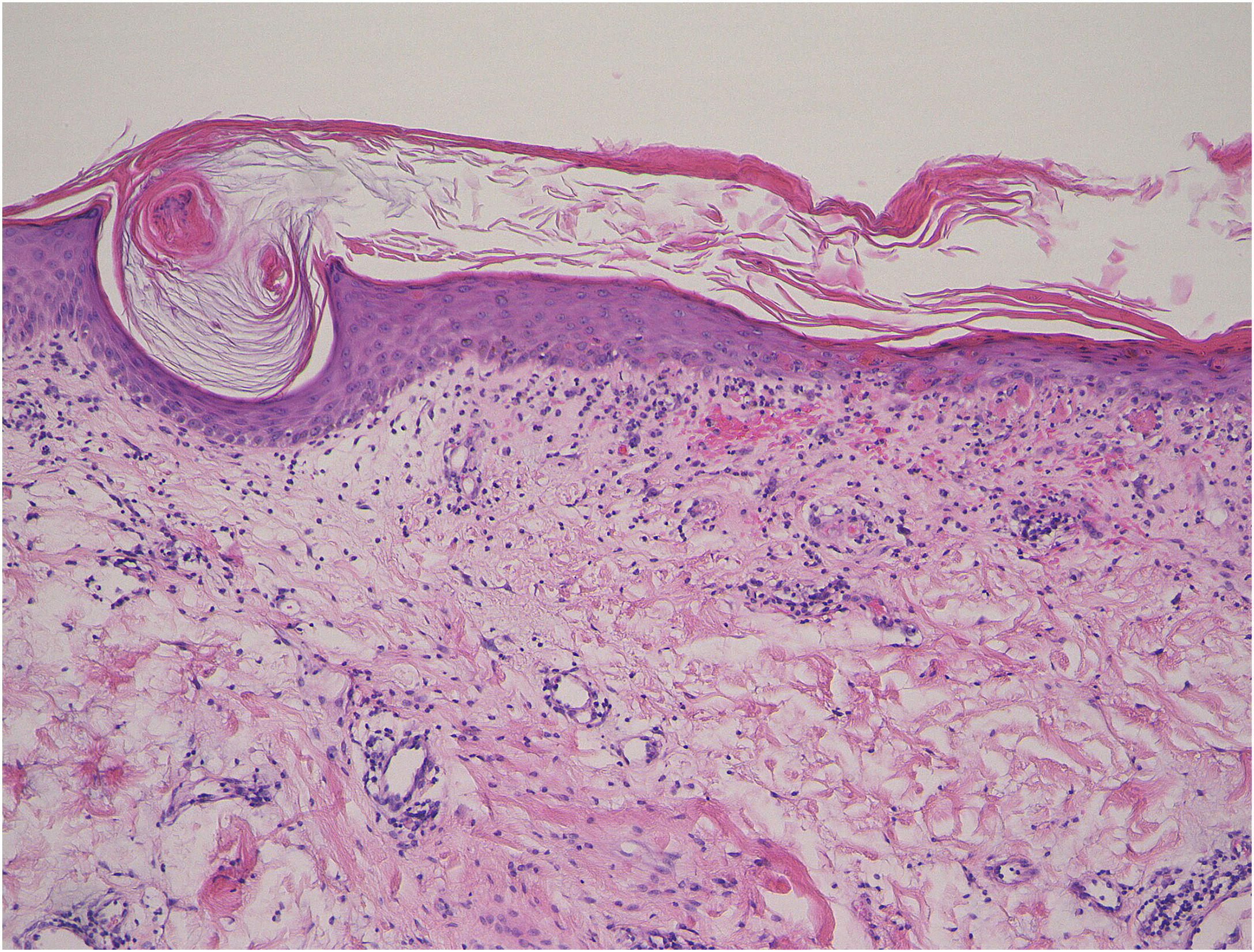 Wong Type Rash Keratotic papules on the thigh: underrecognized skin manifestations of ...