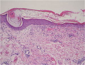 Histological features showing keratotic plug, epidermal atrophy, liquefaction of the basal layers, individual cell keratinization, and mononuclear cell infiltration in the upper dermis: (Hematoxylin & eosin 100 ×).