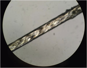 Irregular, undulating hair shaft when examined under light microscopy.