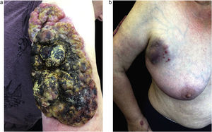 (A) Recurred of disease ‒ Giant, outgrown MCC tumor (01. September). (B) Multiple subcutaneous in transit metastases of an MCC.