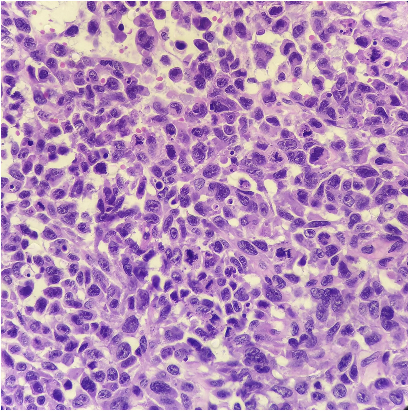 Melanoma With Osteocartilaginous Differentiation Anais Brasileiros De melanoma-with-osteocartilaginous-differentiation-anais-brasileiros-de