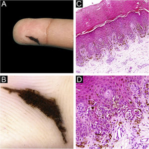 Reed nevus on the finger (A) Clinical features of the lesion. (B) Dermoscopic findings show a parallel ridge pattern with some peripheral streaks. (C) Histopathological findings were tumor cell nests scattered within the epidermis (Hematoxylin & eosin, ×100). (D) Junctional nests were composed of heavily pigmented spindle-shaped melanocytes, vertically oriented (Hematoxylin & eosin, ×200).