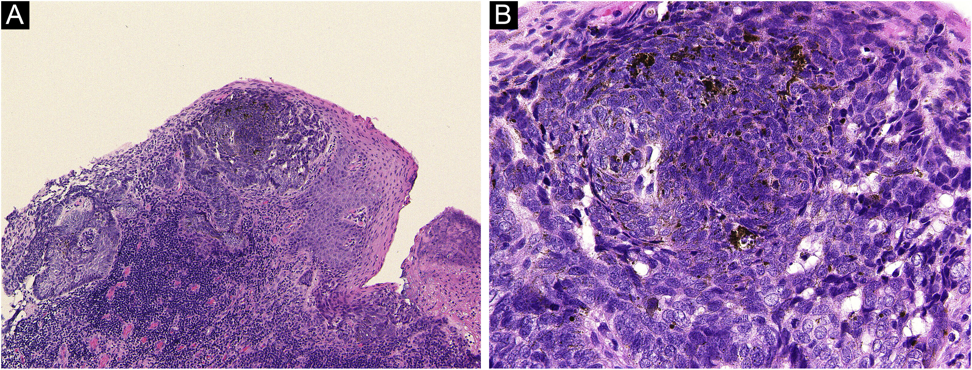 A case of basal cell carcinoma arising in the umbilicus | Anais ...