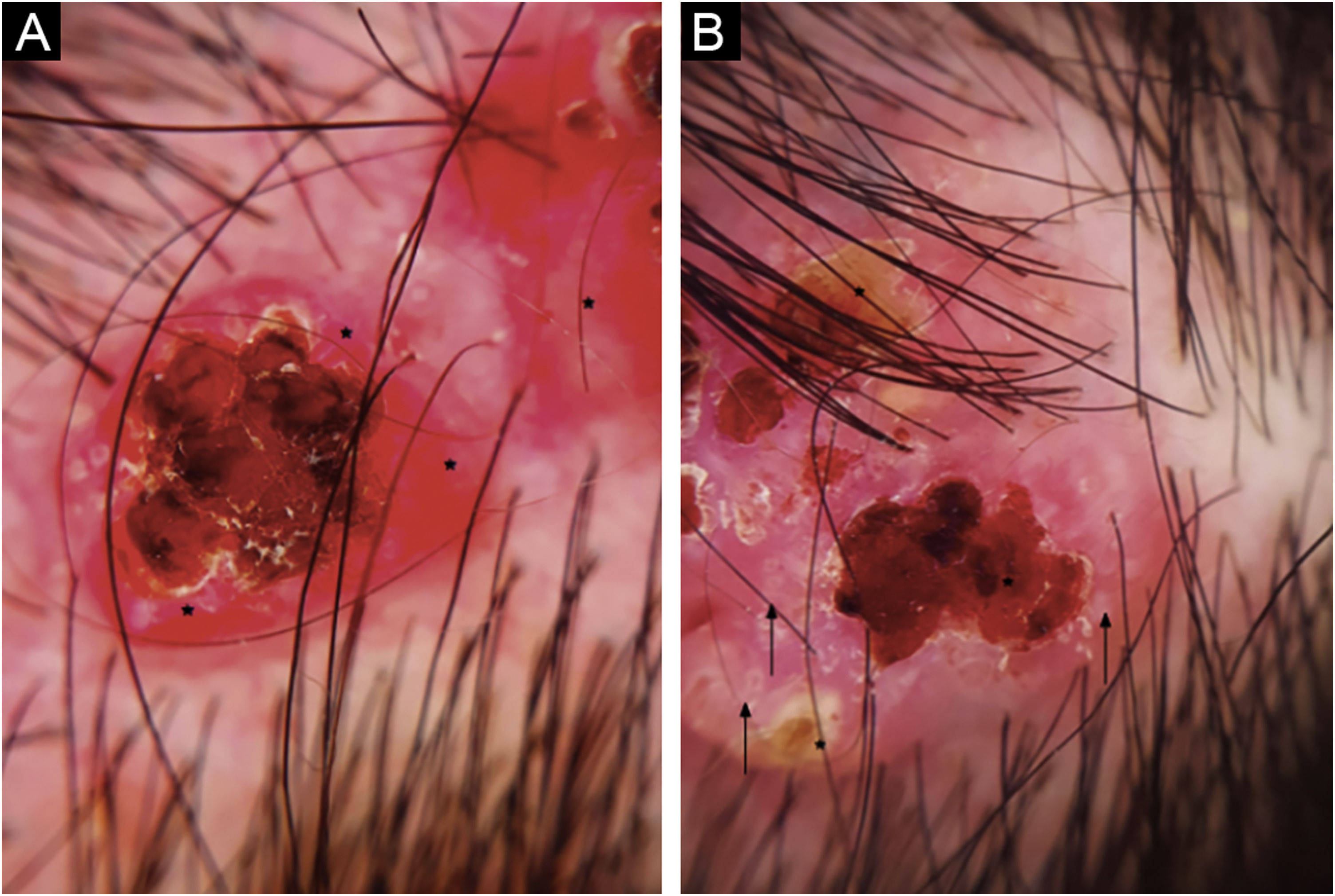 Red Periphery Syringocystadenoma papilliferum in the scalp, with a linear ...