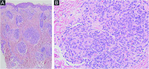 Histopathological features of tufted angioma (TA). (A) Vascular proliferation in the papillary and medium dermis; nodules were composed of tufted vascular vessels lined with endothelial cells. These endothelial cells were fVIII, CD31 and CD34 positive (podoplanin negative). (B) These nodules were surrounded at the periphery by semilunar vascular spaces (podoplanin positive).