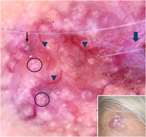 Pink shiny nodule on the right forehead (inset), polarized dermoscopy showed blue/gray-white veil (thin black arrow), bright-white clods and dots resembling rosettes (circles), arborizing vessels (arrowheads) and white shiny streaks (thick arrow).