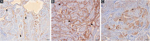 CK5/6 positivity in areas with ductal differentiation (arrows) (A) (CK5/6 ×100). Peripheral layer of myoepithelial cells (arrowheads) (B) (smooth muscle actin ×100). Intratumoral dendritic cells (asteriks) (C) (S100 ×100).