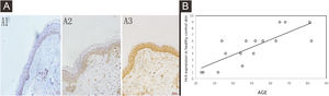 Expressions of HCit in healthy control skin at different ages. 10 high power microscope fields (400×) were randomly selected for observing each section, and scoring was performed as per staining intensity and the percentage of positive cells in the epidermis. The percentage of positive cells was scored as 0‒4 points: < 5%, 0; point 5%‒25%, 1; point 25%‒50%, 2, points 50%‒75%, 3, points ≥ 75%, 4 points. The staining intensity was scored as 0‒3 points: non-staining, 0; Light yellow, 1; Brownish yellow, 2; Chocolate brown, 3. The above-mentioned points were multiplied together to obtain the final score, and higher the score, stronger was the positive expression of HCit. The measured data was expressed as mean ± standard deviation (χ ± s). (A) Representative images of immunohistochemistry of different ages (A1: 32 years old, A2: 51-years old, A3: 81-years old). (B) Representative the correlation plot between age and immunohistochemical score of healthy control skin at different ages. the correlation coefficient was 0.806, p = 0.0002. Data were analyzed using Pearson. HCit, Homocitrulline.