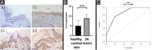 Expression levels of HCit in healthy control skin and lesion of SK. 10 high power microscope fields (400×) were randomly selected for observing each section, and scoring was performed as per staining intensity and the percentage of positive cells in the epidermis. The percentage of positive cells was scored as 0‒4 points: < 5%, 0, point 5%‒25%, 1; point 25%‒50%, 2; points 50%‒75%, 3; points ≥ 75%, 4 points. The staining intensity was scored as 0‒3 points: non-staining 0, Light yellow 1, Brownish yellow 2, Chocolate brown 3. The above-mentioned points were multiplied together to obtain the final score, and higher the score, stronger was the positive expression of HCit. The measured data was expressed as mean ± standard deviation (χ ± s). (A) Representative images of Immunohistochemistry of healthy control skin and SK lesion (A1, A3 represent Immunohistochemistry images of healthy control skin and SK lesion at 51 years old respectively. A2, A4 represent Immunohistochemistry images of healthy control skin and SK lesion at 80-years old respectively). (B) Each Bar represents the mean average of the Immunohistochemistry score ± S.E. and data compared between two grops using Student’s U-tests (***p < 0.001). (C) Representative image of ROC curve of HCit for SK diagnosis. HCit, Homocitrulline; SK, Seborrheic Keratosis; ROC curve, Receiver Operating Characteristic curve.