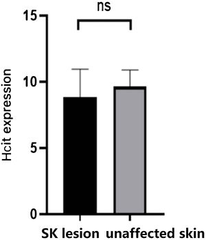 Expression of HCit in SK lesion and unaffected skin. The score was performed as per staining intensity and the percentage of positive cells in the epidermis (method as Fig. 1), The measured data was expressed as mean ± standard deviation (χ ± s), Each Bar represents the mean average of the Immunohistochemistry score ± S.E. Data were analyzed using Student’s t-tests (ns, no significant difference). HCit, Homocitrulline; SK, Seborrheic Keratosis.