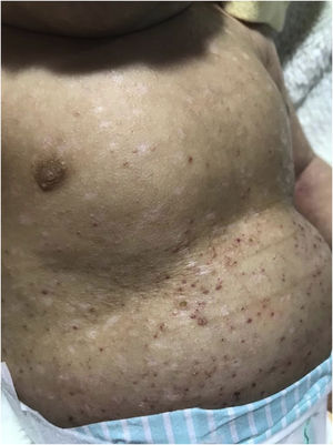 Angiomatous papules with hematic crusts on top and some flat, hypochromic papules, with a shiny appearance on the trunk.