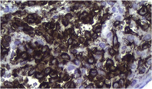 Positive immunohistochemistry for CD1a.