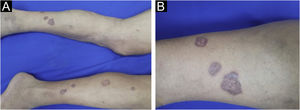 (A) Violaceous lesions, with raised edges and an atrophic center, with a shiny, lichenoid surface on the lower limbs, ranging in size from 0.5 to 2 cm. (B) Lichenoid lesion in greater detail, showing its annular aspect.