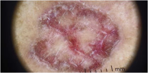 Dermoscopy of lesion on the right lower limb, showing linear Wickham striae.