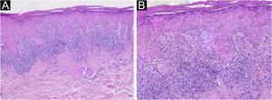 Histopathology of the right lower limb lesion. (A) Epidermis showing compact hyperkeratosis, parakeratosis, hypergranulosis, mild irregular acanthosis, mild spongiosis and superficial dermis with perivascular and periadnexal lymphohistiocytic lichenoid inflammatory infiltrate in a band-like disposition, without alterations in the deep dermis (Hematoxylin & eosin, ×50). (B) Higher magnification showing basal vacuolar changes, a subepidermal cleft and rare apoptotic keratinocytes (Hematoxylin & eosin, ×100).