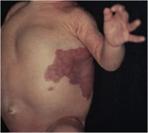 Detail of the vascular malformation in the thorax and thoracoabdominal tumor.