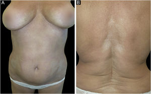 (A) Symmetrical, whitish, ivory, xerotic and sclerotic plaques, with a diameter ≥3 cm. (B) Whitish and sclerotic skin plaque with a “cigarette-paper” appearance on the patient