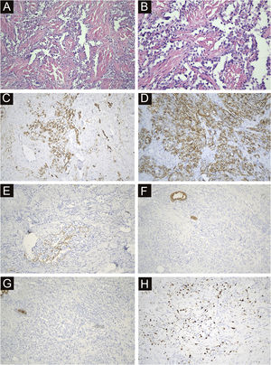 Immunohistochemical and antibody staining of STS. (A) The histopathologic study showed irregular lumens with infiltrative growth in the dermis and subcutaneous tissue, some lumens fused and communicated with each other, and red blood cells could be seen in some lumens. (×200). (B) The epithelium in the lumen was obviously heteromorphic, protruding into the lumen like a tack, and the nucleus was large and darkly stained. (×400). (C) CD34 positive (×200). (D) CD31 positive (×200). (E) D2-40 Locally positive (×200). (F) CK negative (×200). (G) EMA negative (×200). (H) ki67 index 15% (×200).