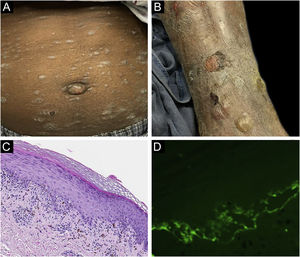 Case 1. (A) Scaly papules and plaques on abdomen. (B) Blistering. (C) Brisk lichenoid interface dermatitis. (D) Linear C3 deposition at the BMZ.