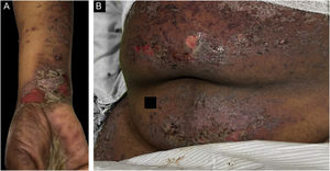 Case 3. (A) Scaly lichenoid and bullous lesions on wrists (B) abdomen.