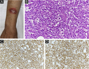 (A) Clinical findings: A painful subcutaneous tumor is observed in the right forearm. (B) Small round atypical cells are diffusely proliferating, showing a bottom-heavy appearance (Hematoxylin & eosin, ×200). (C) Positive CD20 immunostaining (Immunohistochemical staining for MYC × 400). (D) Positive CD79a immunostaining (immunohistochemical staining for BCL-2, ×400).