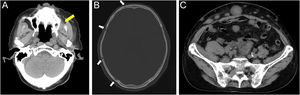 Computed tomography findings. (A) Soft tissue tumor in the left maxillary sinus (yellow arrow). (B) Osteolytic changes in the skull (white arrows). (C) Multiple abdominal subcutaneous and intraperitoneal metastases.