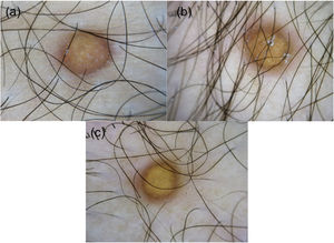 (A–C) Dermoscopy reveals yellow homogenous areas, central white network and pinkish halo.
