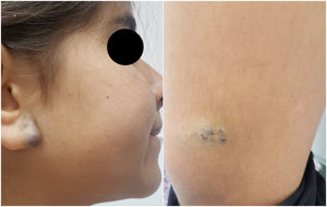 BRBNS. Violaceous papule on the right earlobe and violaceous lesion on the left thigh, with slight swelling on palpation.