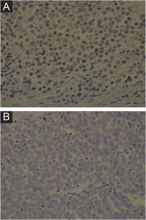 Immunohistochemistry for MCPyV performed on Merkel cell carcinoma slides. (A) Immunohistochemistry slide from a patient showing a positive result for MCPyV (×400 magnification). (B) Immunohistochemistry slide from a patient showing a negative result for MCPyV (×400 magnification).