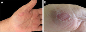 (A) Clinical record of the lesion after four years of evolution. (B) Detail of the lesion at higher magnification: dermatosis on the thenar region of the left palm, characterized by a slightly erythematous area with raised borders.