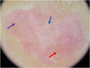 Dermoscopic image, with polarized light, showing white dots (blue arrow), red dots (red arrow) and whitish striae in the central region of the lesion.