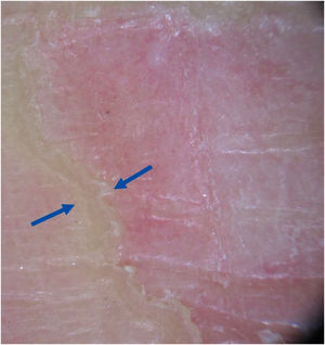 In greater detail, dermoscopic image showing a clear difference in relief between the border and the center of the lesion.