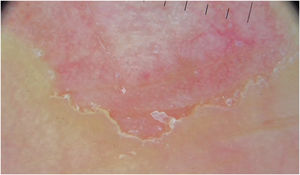 Dermoscopic image of the medial border of the lesion. At this higher magnification, it is possible to see the “step-ladder” pattern corresponding to the anatomopathological image in Fig. 5.