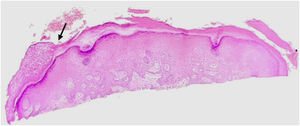 Histopathology of the lesion, showing a well-circumscribed area of clear cut decrease in the stratum corneum (arrow), (Hematoxylin & eosin, x40).