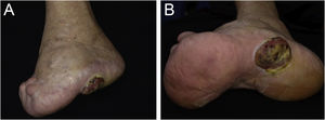 (a) Anatomical deformity in the left foot and absence of toes, secondary to a burning accident in childhood, that healed by second intention. (b) Vegetating nodular-tumor lesion with hematic crusts, well-defined borders, blackened spots, and overlying keratosis, affecting the plantar region and lateral face of the left foot.