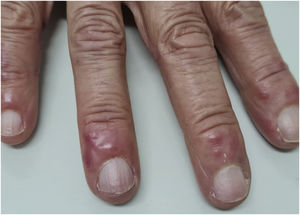 Mild acrocyanosis and erythematous-infiltrated papules on the distal region of the fingers.