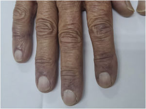 Persistence of acrocyanosis and full resolution of papules.