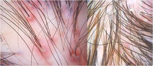 Follicular pustules, desquamation and perifollicular erythema on dermoscopy. Areas with absence of follicular ostia; however, with the presence of polytrichia.
