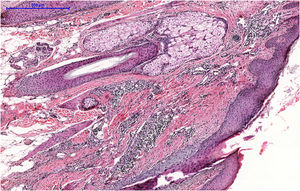 Mixed perifollicular inflammatory infiltrate in the region between the isthmus and the infundibulum, with follicular destruction (Hematoxylin & eosin, ×100).