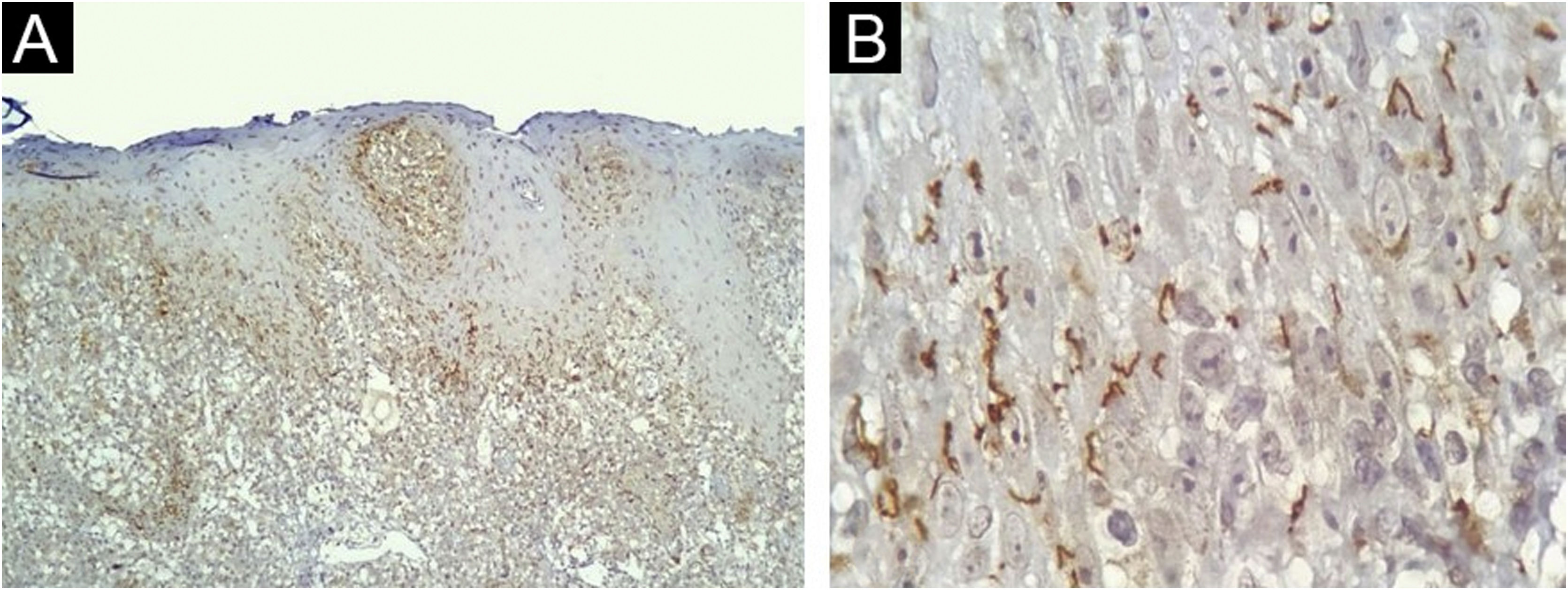 Treponema Rash Immunohistochemical detection of Treponema pallidum in skin samples ...