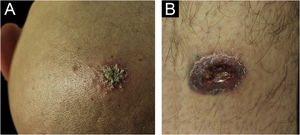 (A) Erythematous plaque covered by a meliceric crust on the scalp. (B) Ulceration with clear bottom and framed edges, above the right medial malleolus.