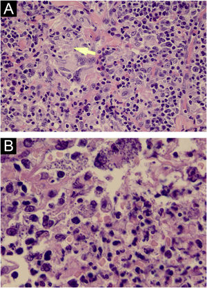 (A) Amastigote parasites inside macrophages (yellow arrow; Hematoxylin & eosin, ×400). (B) Amastigote parasites inside macrophages (Hematoxylin & eosin, ×1000).